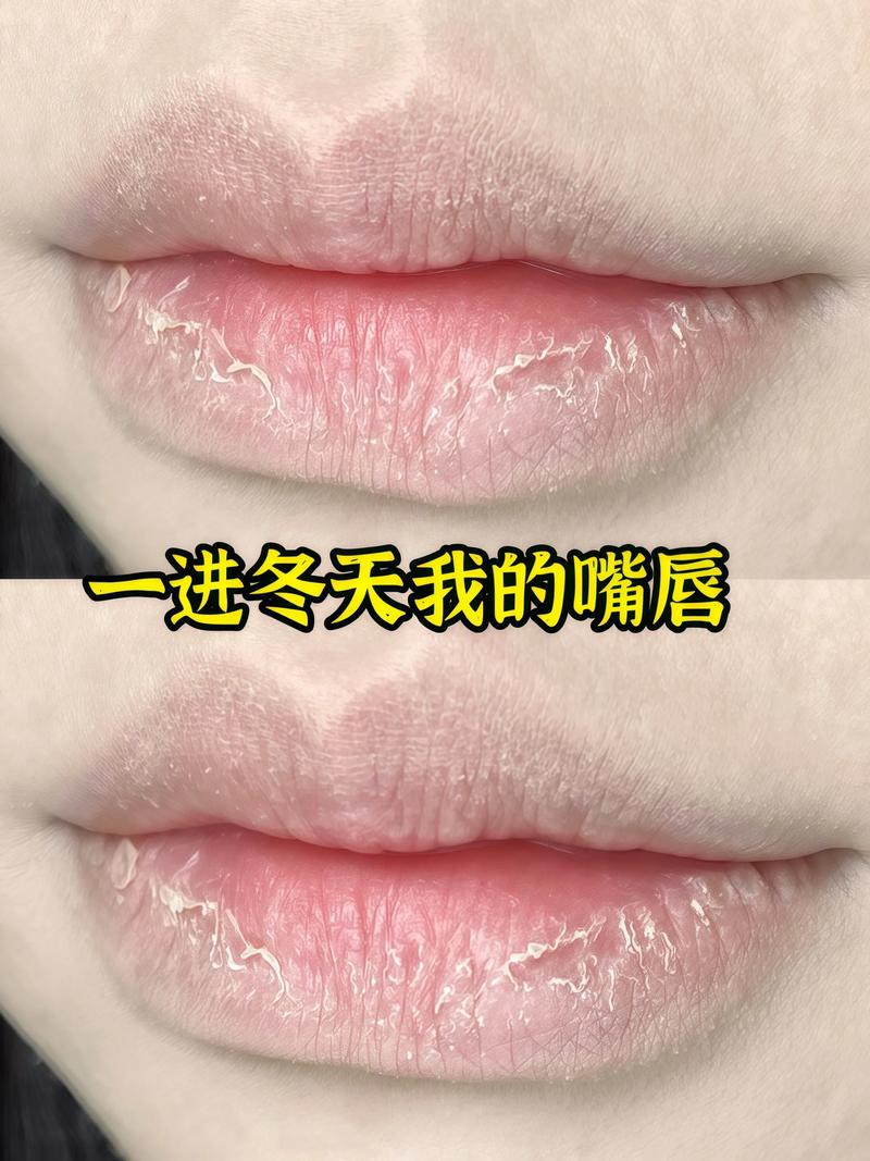 为什么冬天嘴唇容易干裂?这3个原因你可能不知道