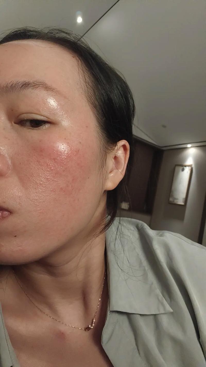 口罩戴久了皮肤过敏？皮肤科医生支招